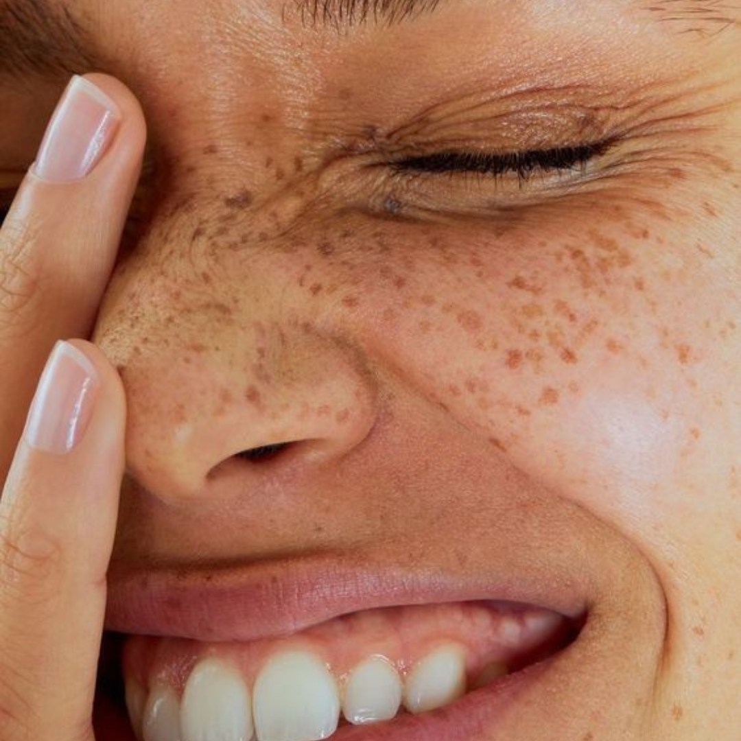 The Ultimate Guide to Hyperpigmentation