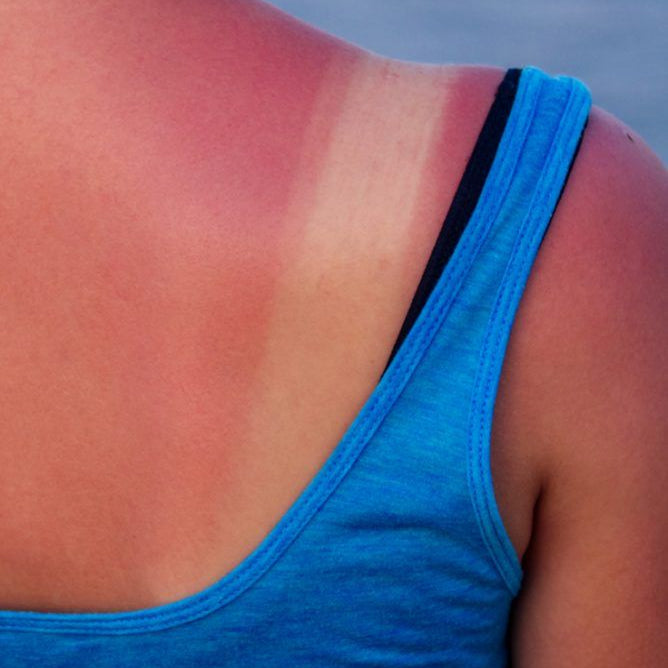 How To Care For Sunburned Skin