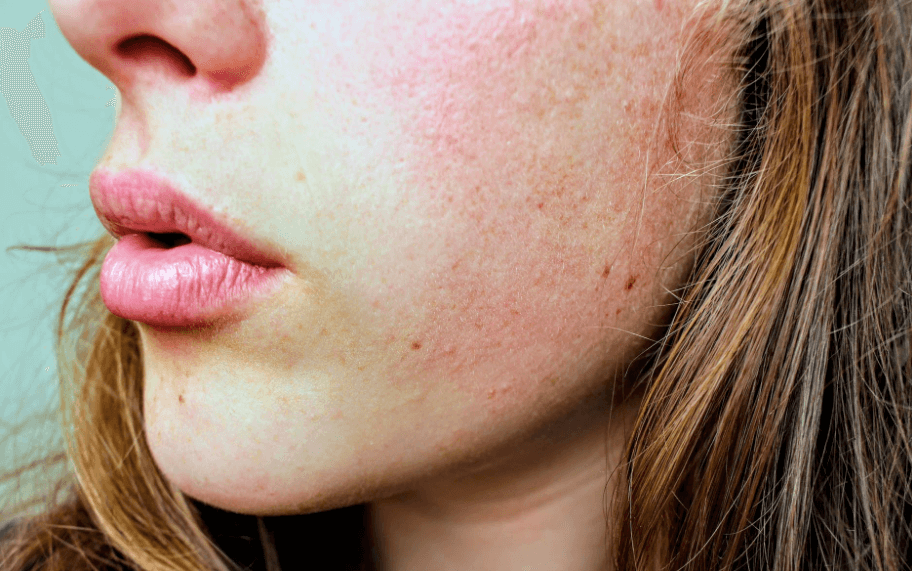 I Have Rosacea - What Should I Do?